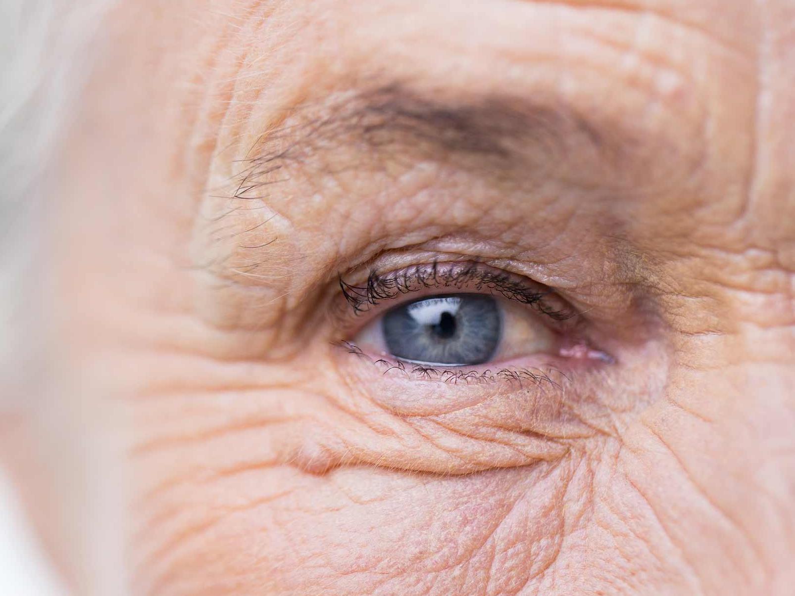 Imaginea prezintă un prim-plan al unui ochi nesănătos, ilustrând potențialele pericole pentru adnexa oculară. 