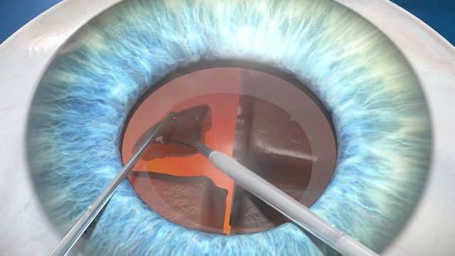 Facoemulsificarea