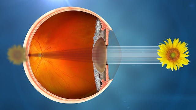 Vedere afectată de cataractă