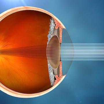 Vedere afectată de cataractă