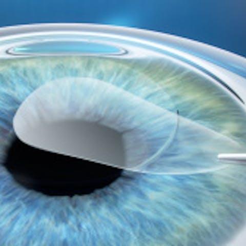 Extragerea lenticulei