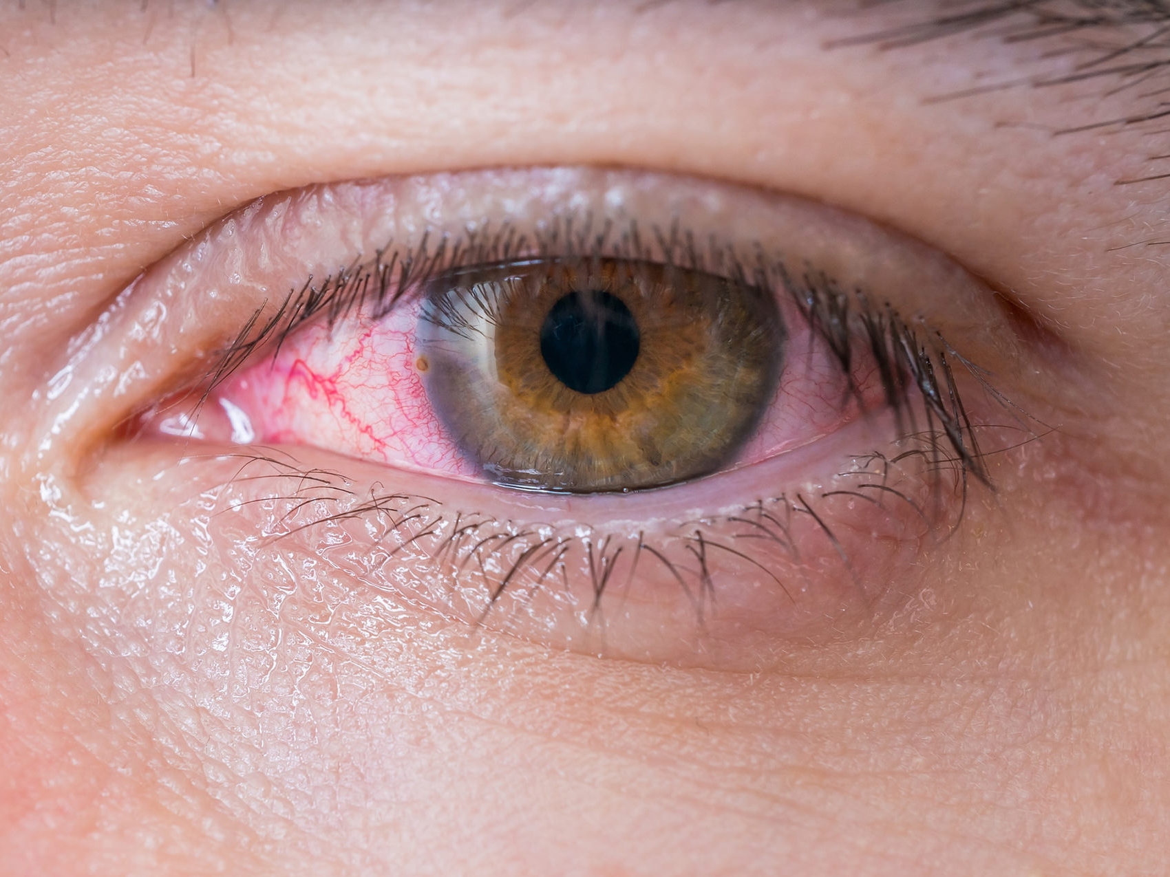 Imaginea prezintă un prim-plan al unui ochi nesănătos, ilustrând apariția unor potențiale pericole pentru ochi. 